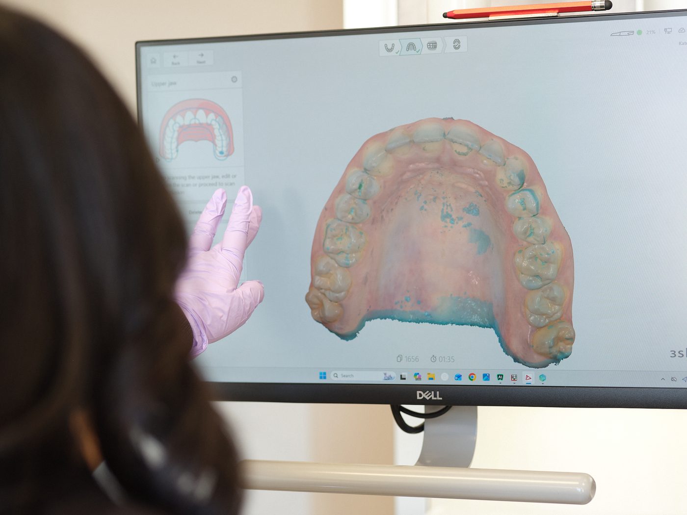 3D digital scan of a patient's arch on the treatment room monitor